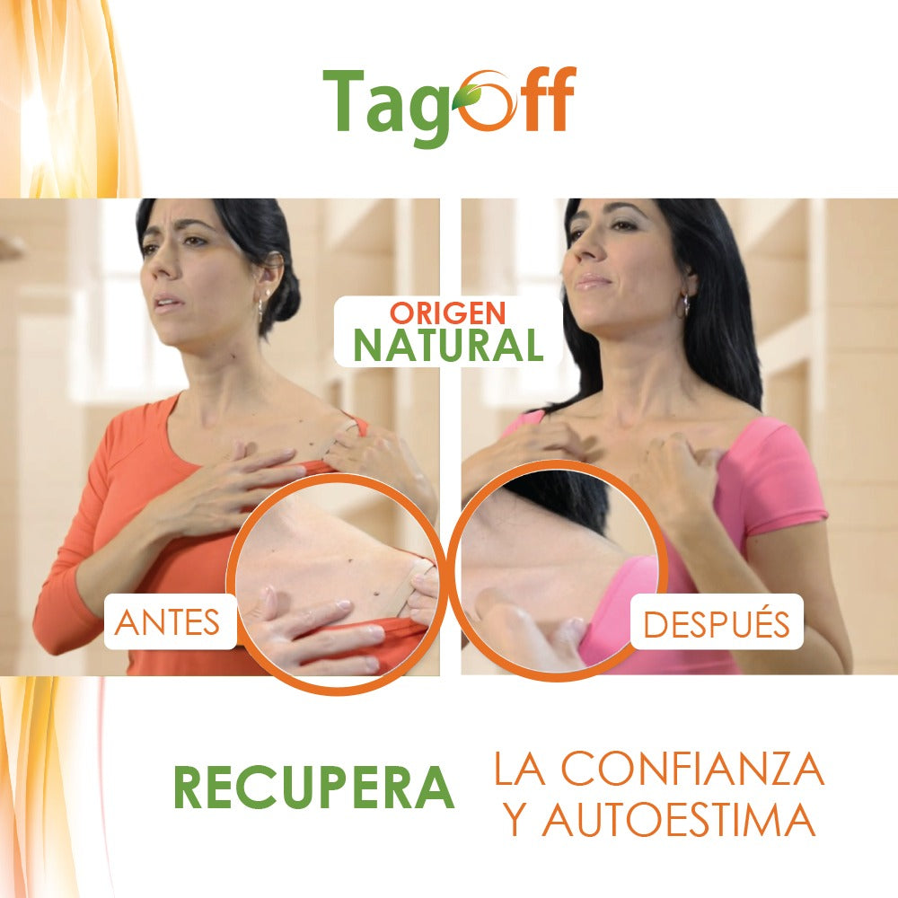 TagOff ✨ Tratamiento tópico natural para verrugas y protuberancias.  Adiós verrugas desde casa