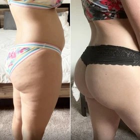 Antes y después con Vibro Sculpt en glúteos y muslos
