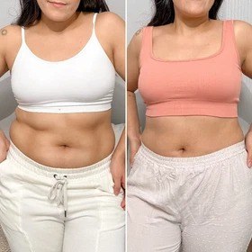 Antes y después con Vibro Sculpt en abdomen