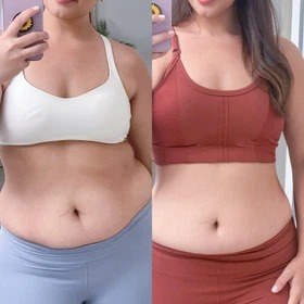 Antes y después con Vibro Sculpt en abdomen