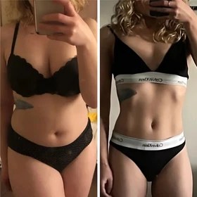 Antes y después con Vibro Sculpt en abdomen