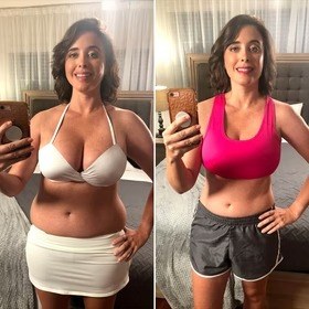 Antes y después con Vibro Sculpt en abdomen y cintura