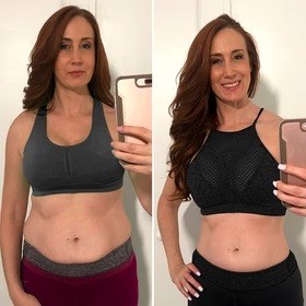 Antes y después con Vibro Sculpt en abdomen
