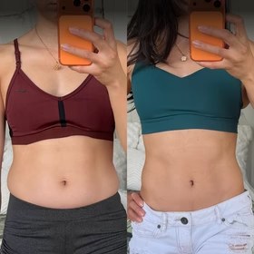 Antes y después con Vibro Sculpt en abdomen