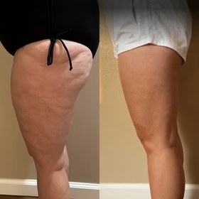 Antes y después con Vibro Sculpt en muslos