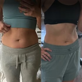 Antes y después con Vibro Sculpt en abdomen