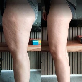 Antes y después con Vibro Sculpt en muslos
