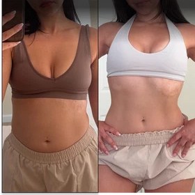 Antes y después con Vibro Sculpt en abdomen